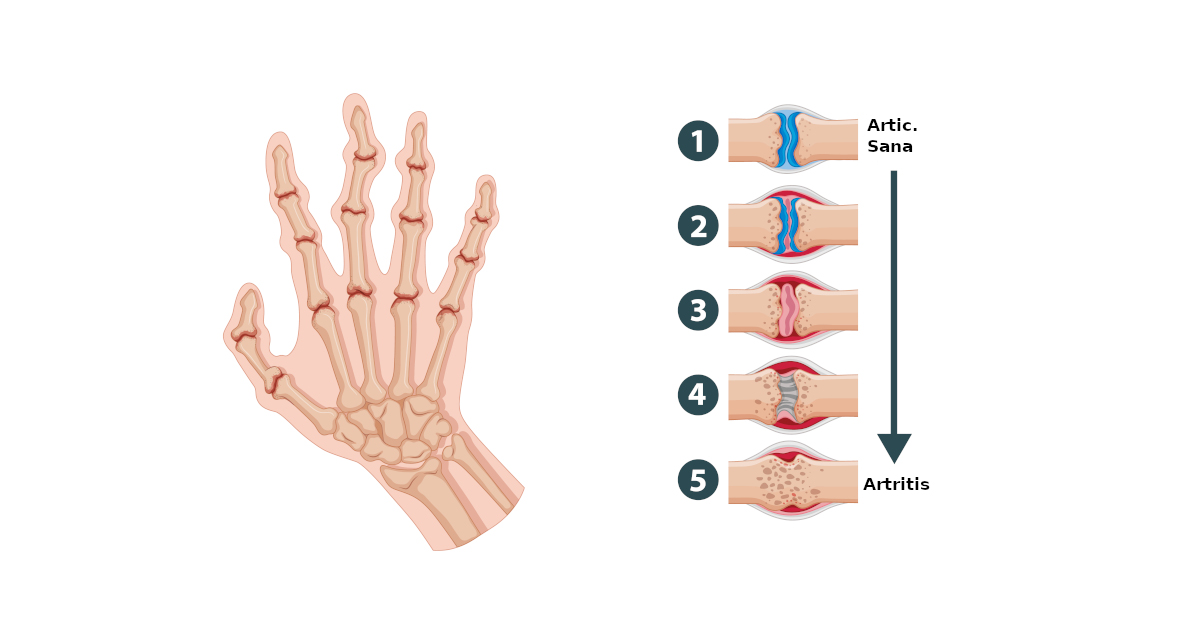 Incapacidad por artritis