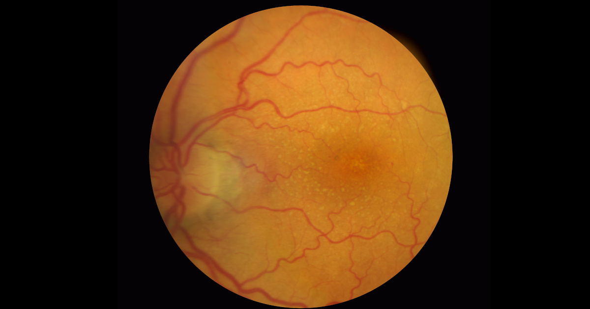 Incapacidad por retinopatía